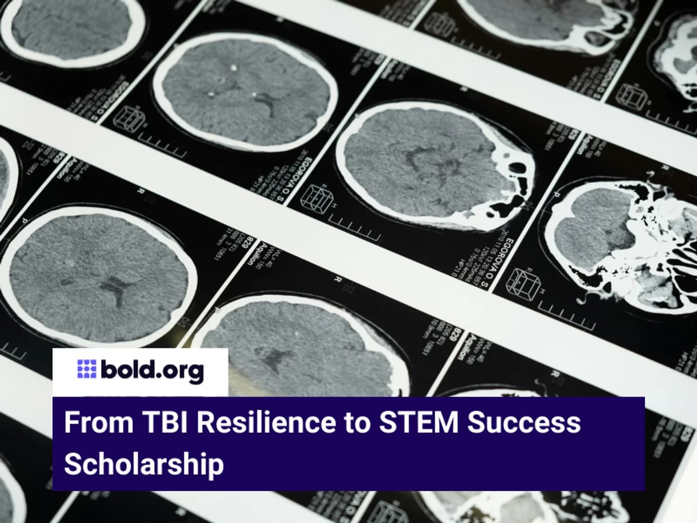 From TBI Resilience to STEM Success Scholarship